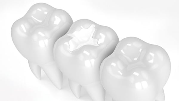 White fillings
