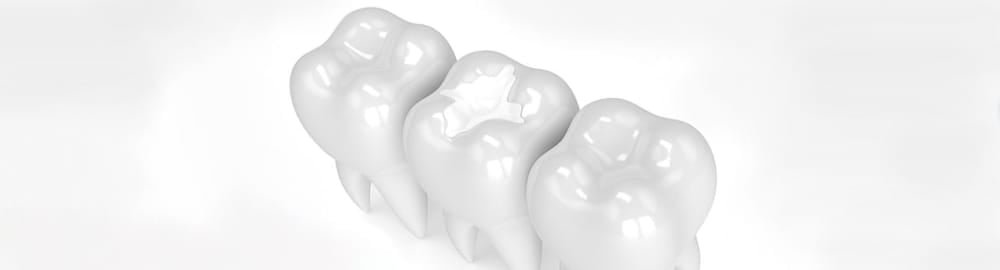 White fillings