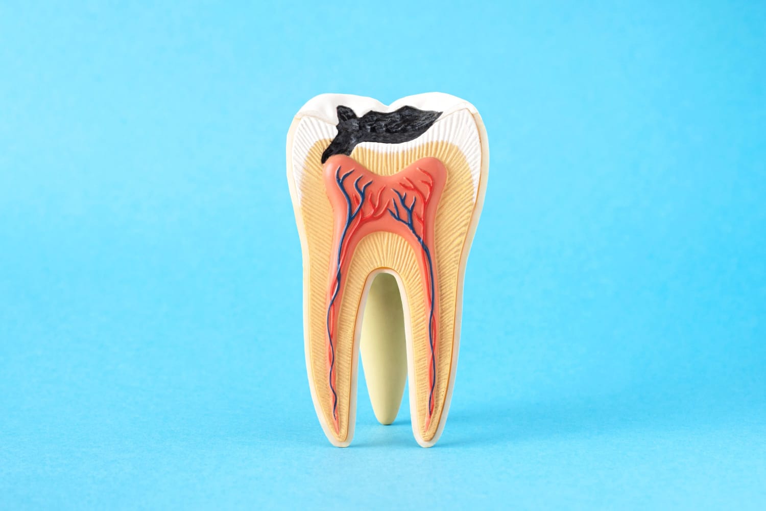 model of tooth with decay