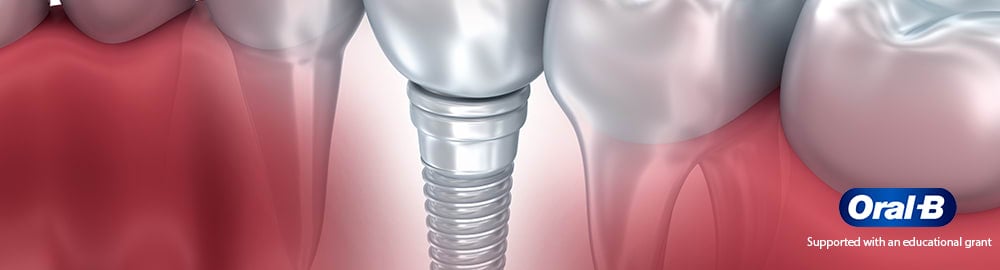 Implants