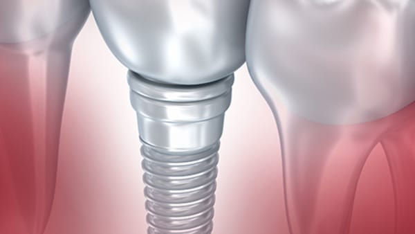 Implants