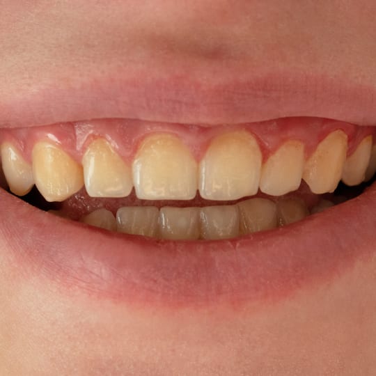 A smile with weakened enamel