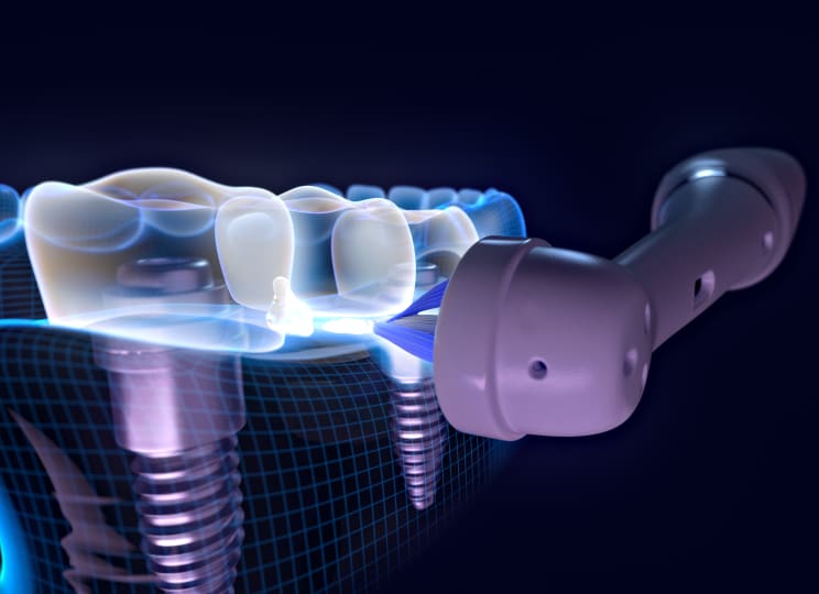 This head has been designed to clean around implants