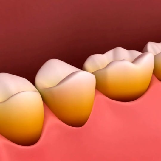 drawing of teeth with staining